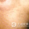 流行性斑疹伤寒的症状有哪些