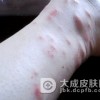 自体敏感性皮炎的原因什么