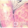 自身敏感性皮炎发病机制