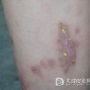 引起自体敏感性皮炎的原因是什么呢