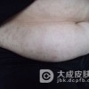 毛囊角化症的症状表现有哪些