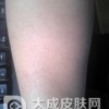 专家解答：毛囊角化症是否传染