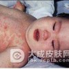 小儿皮肤黏膜淋巴结综合征的症状有哪些
