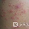 究竟有什么种类的药疹