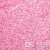 平滑肌瘤治疗方法是什么？