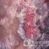 增殖性红斑怎么护理好呢