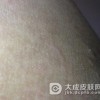 皮肤癣菌病外用药怎么用