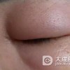 为什么会得血管性水肿