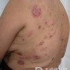 皮肤B细胞淋巴样结节型增生如何预防
