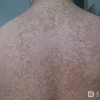 融合性网状乳头瘤病的症状有哪些