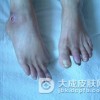 硬皮病对皮肤粘膜的损害