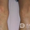 硬皮病的早期表现有哪些