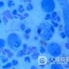得了组织细胞吞噬性脂膜炎怎么办