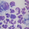 如何预防组织细胞吞噬性脂膜炎