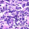 组织细胞吞噬性脂膜炎是由什么原因引起的