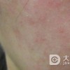 去除自敏性皮炎的病因