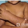 小儿丘疹性肢端皮炎有什么症状