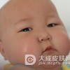 孩子患血管性水肿怎么办
