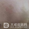 伊藤痣会遗传给下一代吗