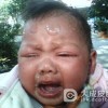小儿神经皮肤综合征的病因