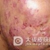 职业性痤疮要怎么治疗