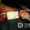 转移性皮肤钙化病的病因有哪些