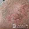 怎样预防穿凿脓肿性头部毛囊炎及毛囊周围炎