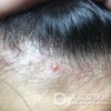 穿凿脓肿性头部毛囊炎及毛囊周围炎如何预防