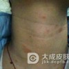 硬红斑的危害有哪些