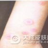 硬红斑有什么典型症状