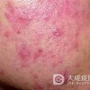恙螨皮炎的症状有哪些