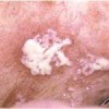 慢性黏膜皮肤念珠菌病都有哪些表现