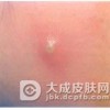 面部疖痈都有哪些并发症
