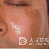 硬化症的三种类型介绍