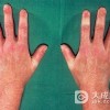 耳硬化症有哪些临床表现