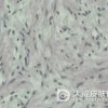 得了外阴神经纤维瘤怎么办