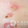 化脓性汗腺炎如何预防呢