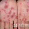 梅毒胎儿能够治愈吗