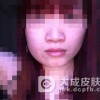 杆菌性上皮样血管瘤病如何预防