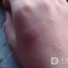 痧子如何预防