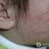 痧子的症状有哪些