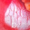 口腔粘膜白斑是如何发病的