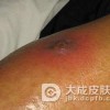 硬红斑对内脏的损害不容忽视
