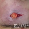 幼年性黄色肉芽肿的治疗方法有哪些