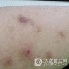 黑布拉痒疹食疗方法有哪些