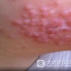 黑布拉痒疹的饮食保健