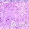 硬红斑与冷超敏反应
