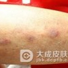 硬红斑和结节性血管炎的相似之处