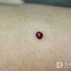 化脓性肉芽肿的症状有哪些