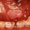 更年期妇女容易得粘膜白斑